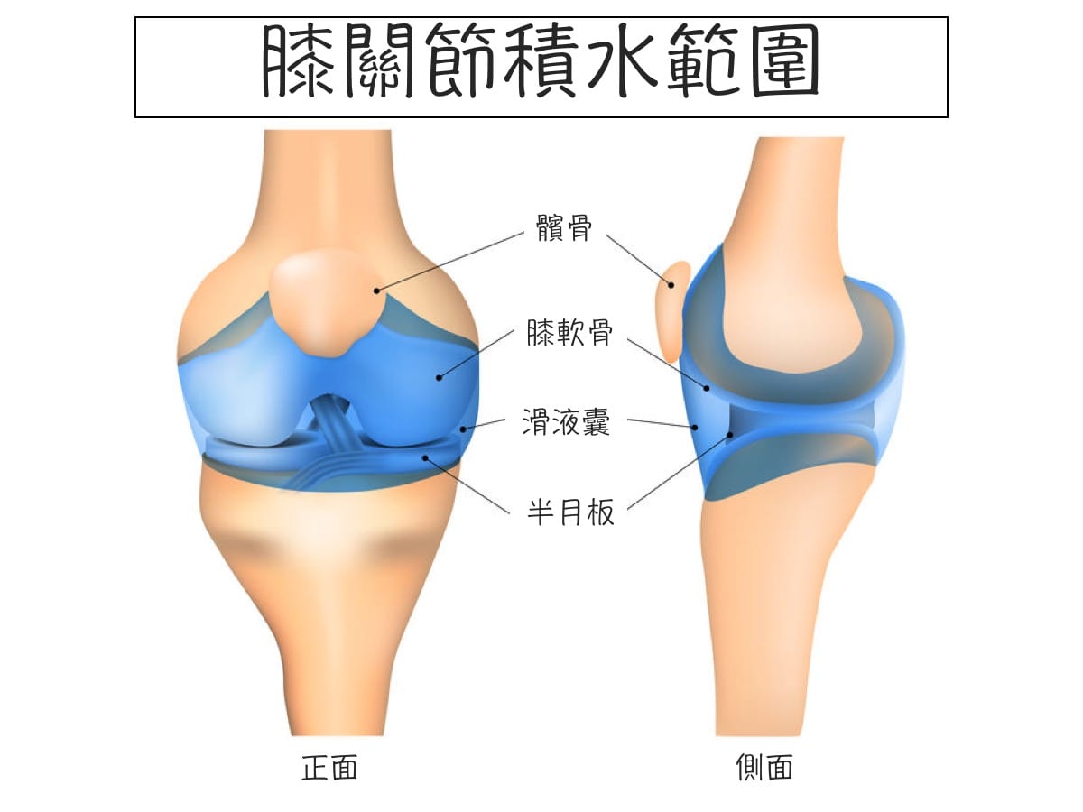 膝關節積水2
