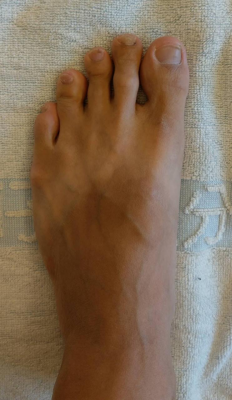 健康的腳趾頭，五根趾頭自然向前且自然分開。無跨趾、拇趾外翻等狀況。