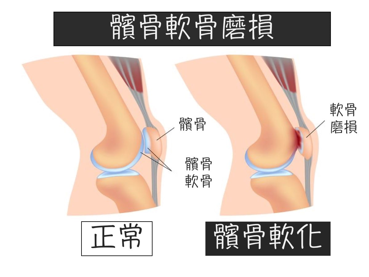 跑者膝-髕骨軟骨磨損
