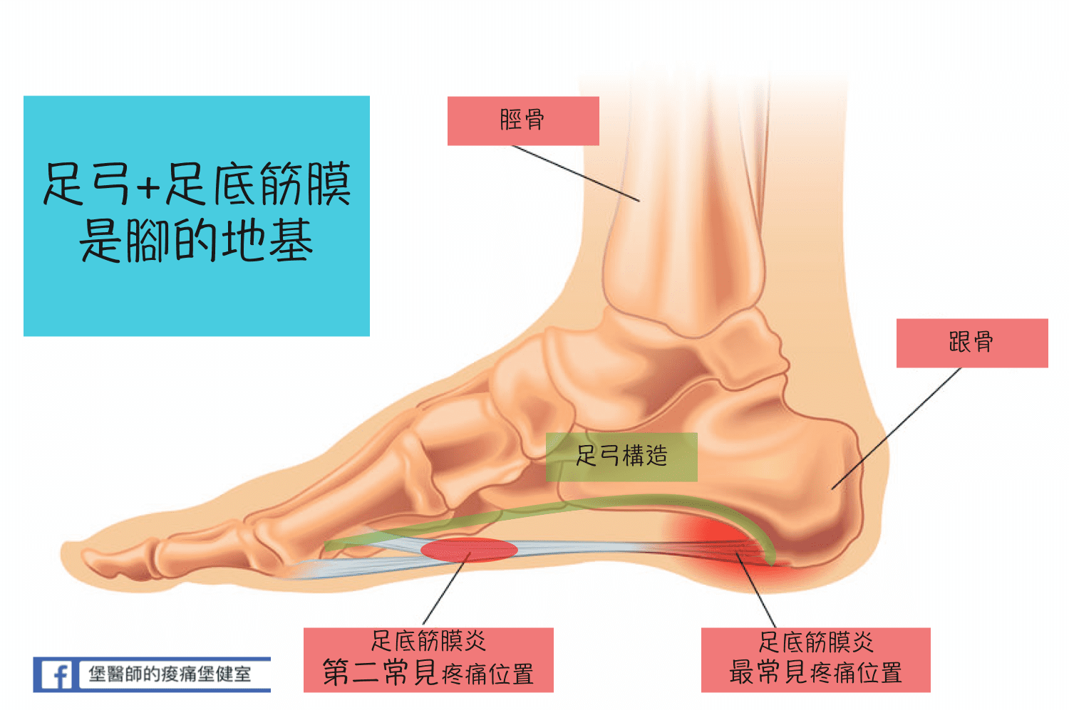 足底筋膜炎構造