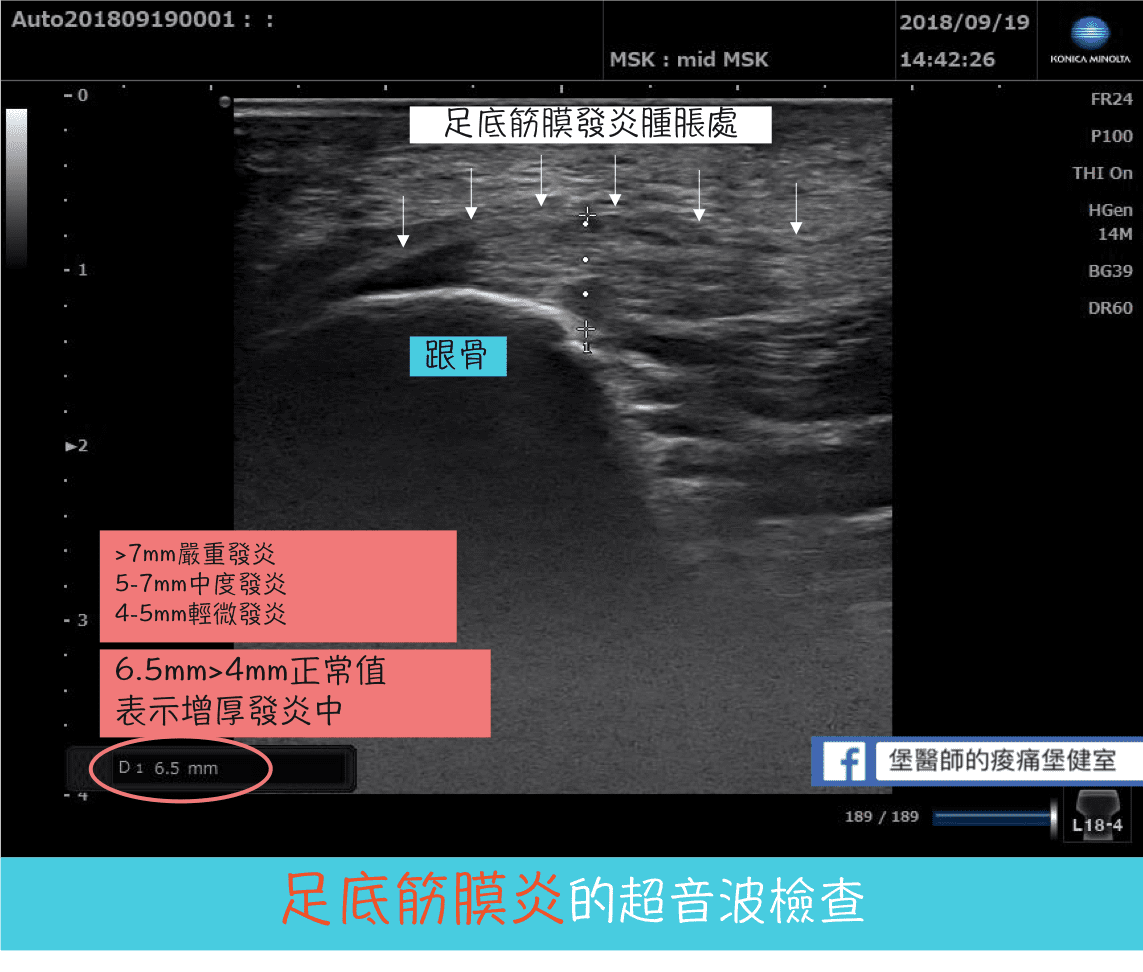 足底筋膜炎的超音波檢查