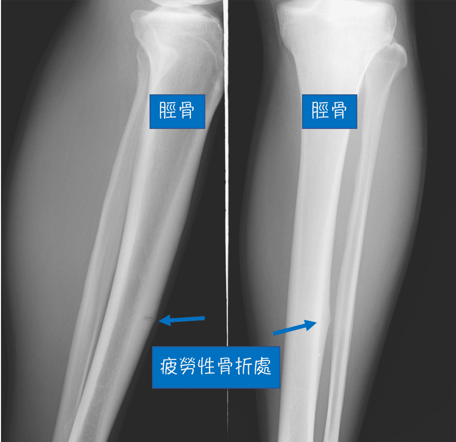 跑步小腿痛 是疲勞性骨折 還是夾脛症 台北原力復健科診所 侯鐘堡醫師