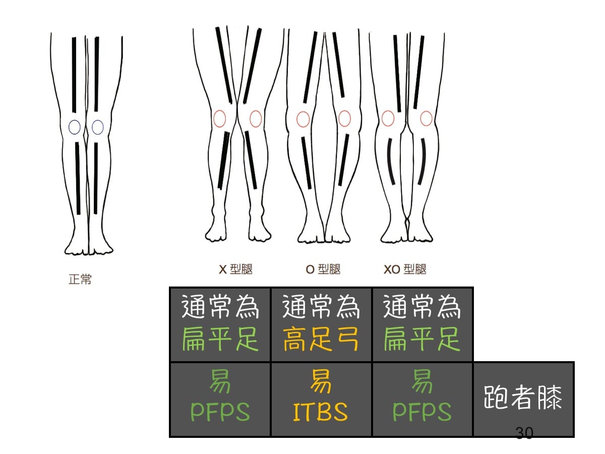 腿型與足弓的關聯