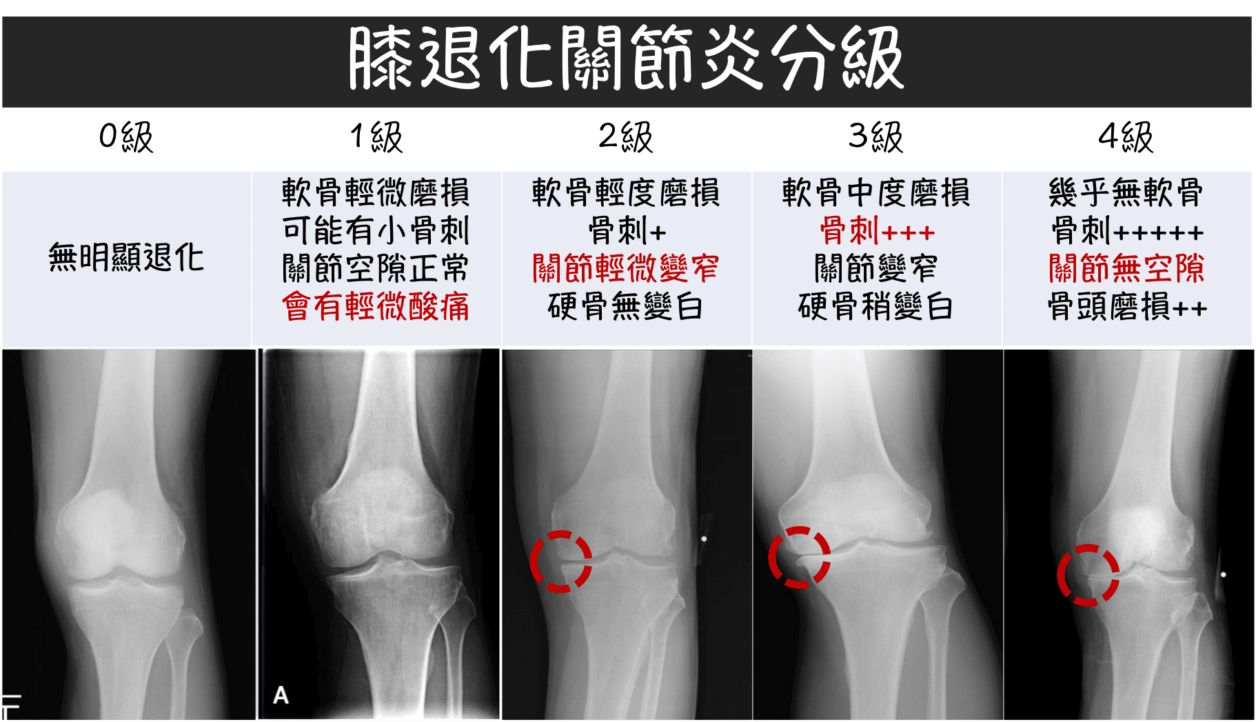 膝關節退化X光分級