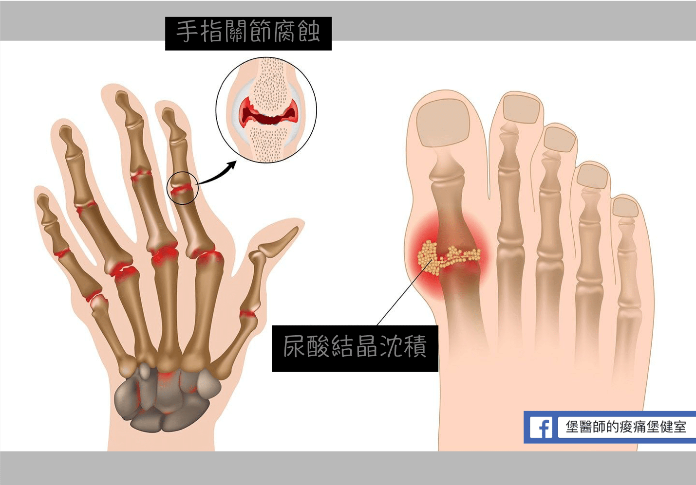 尿酸結晶堆積及手指關節腐蝕