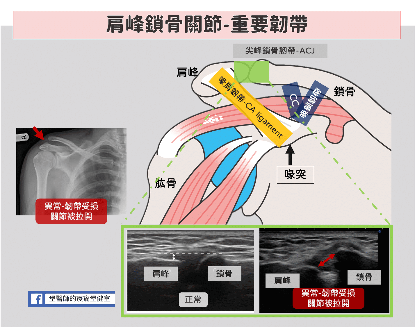 肩峰鎖骨韌帶構造ACJ