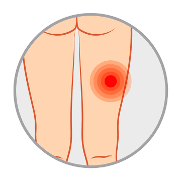 腿後激痛點 hamstring pain