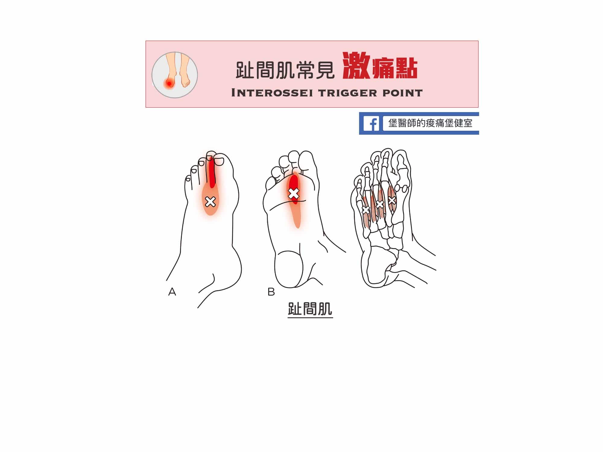 足部痛-趾間肌常見激痛點