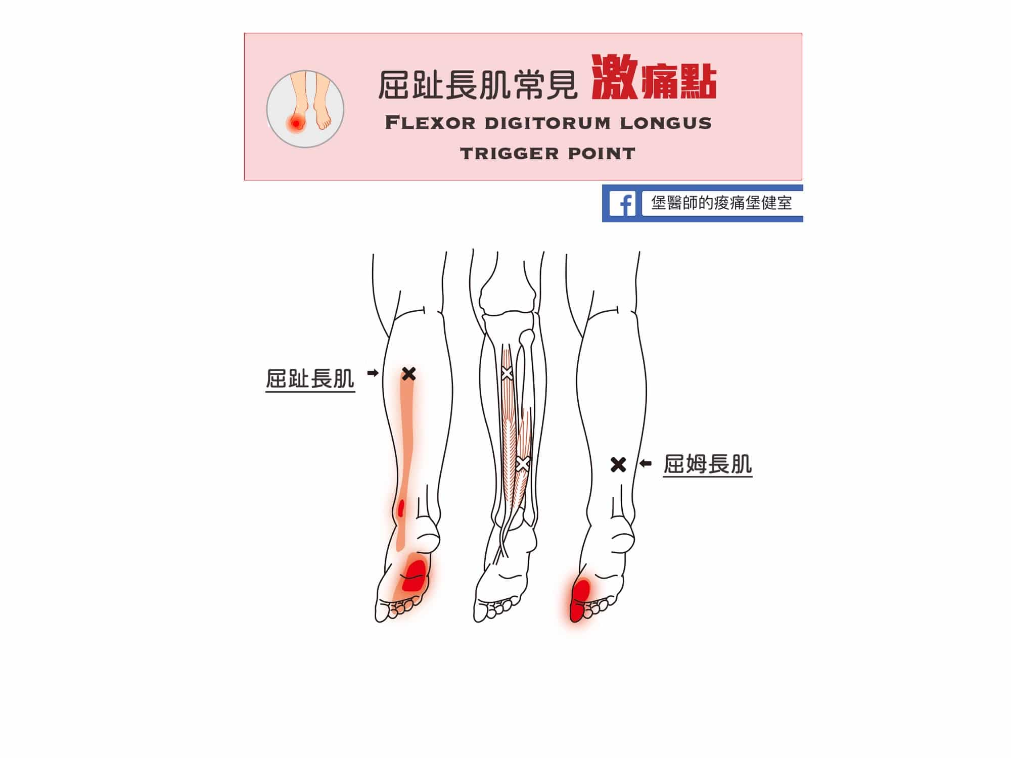 足部腳踝小腿痛-屈趾長肌常見激痛點