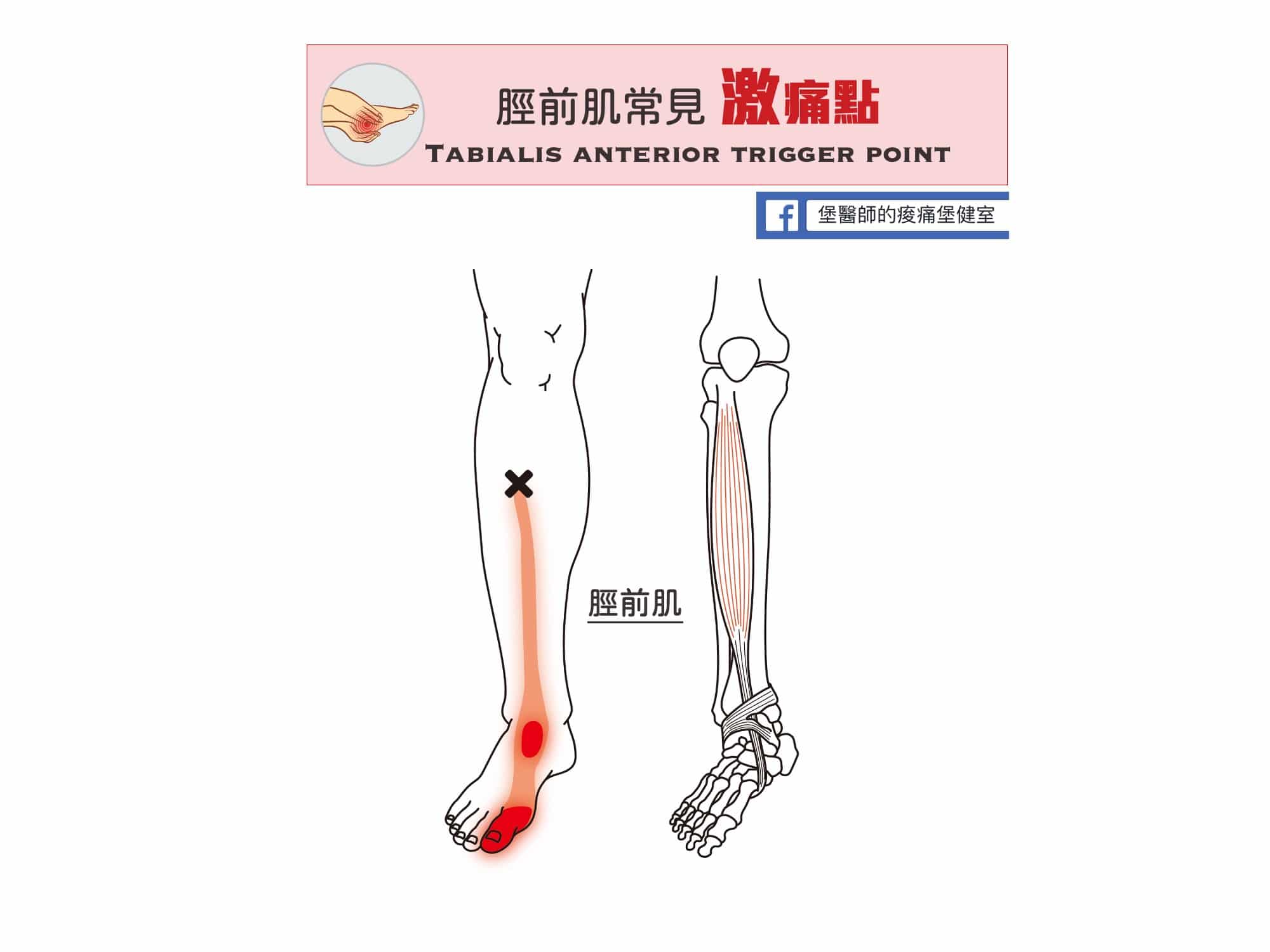 足部腳踝小腿痛-脛前肌常見激痛點