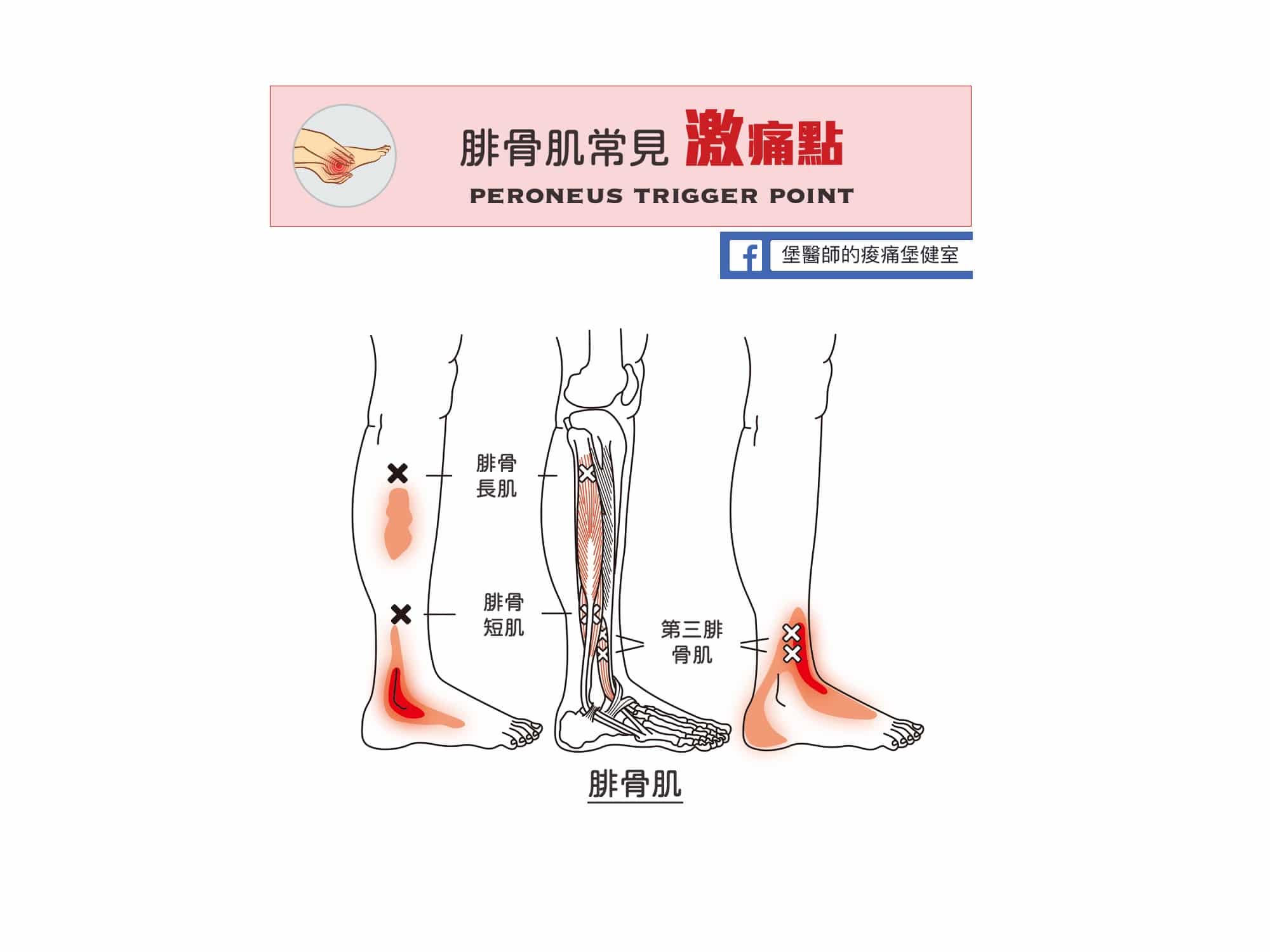 足部腳踝小腿痛-腓骨肌常見激痛點