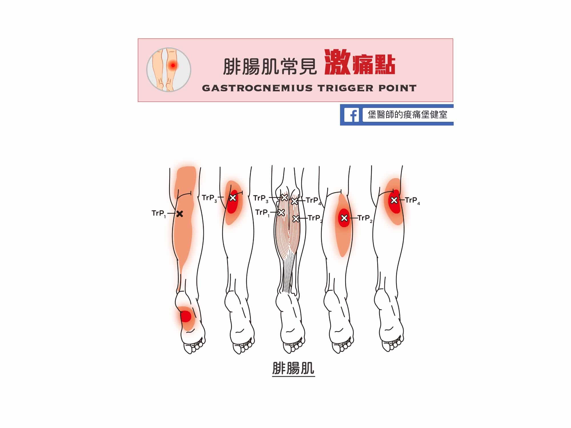 小腿痛-腓腸肌常見激痛點