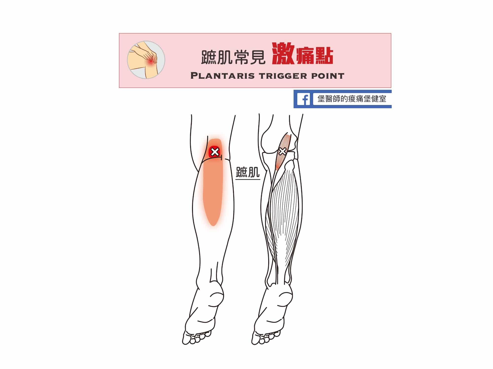 膝蓋後側痛-蹠肌常見激痛點