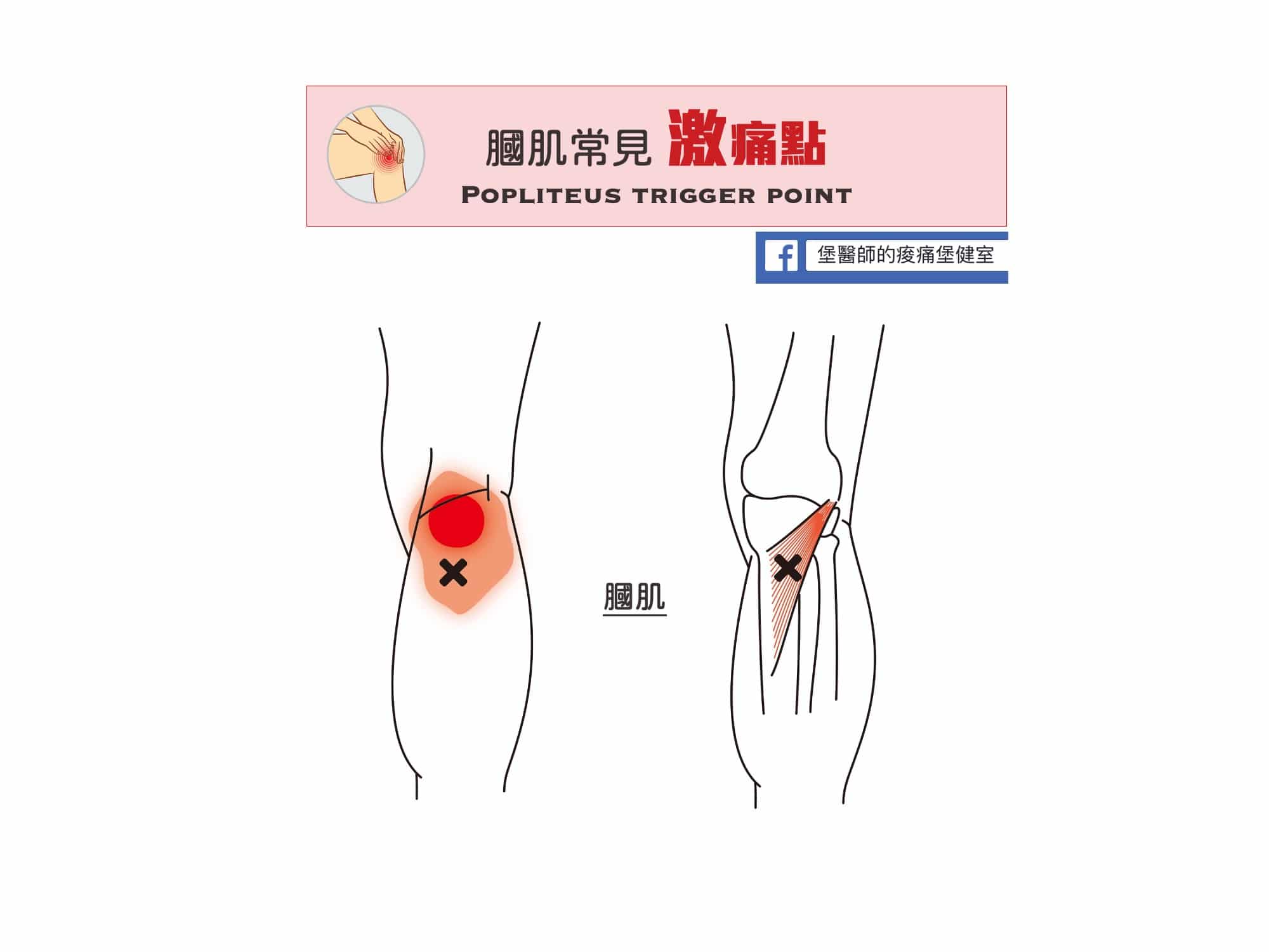 膝蓋後側痛-膕肌常見激痛點