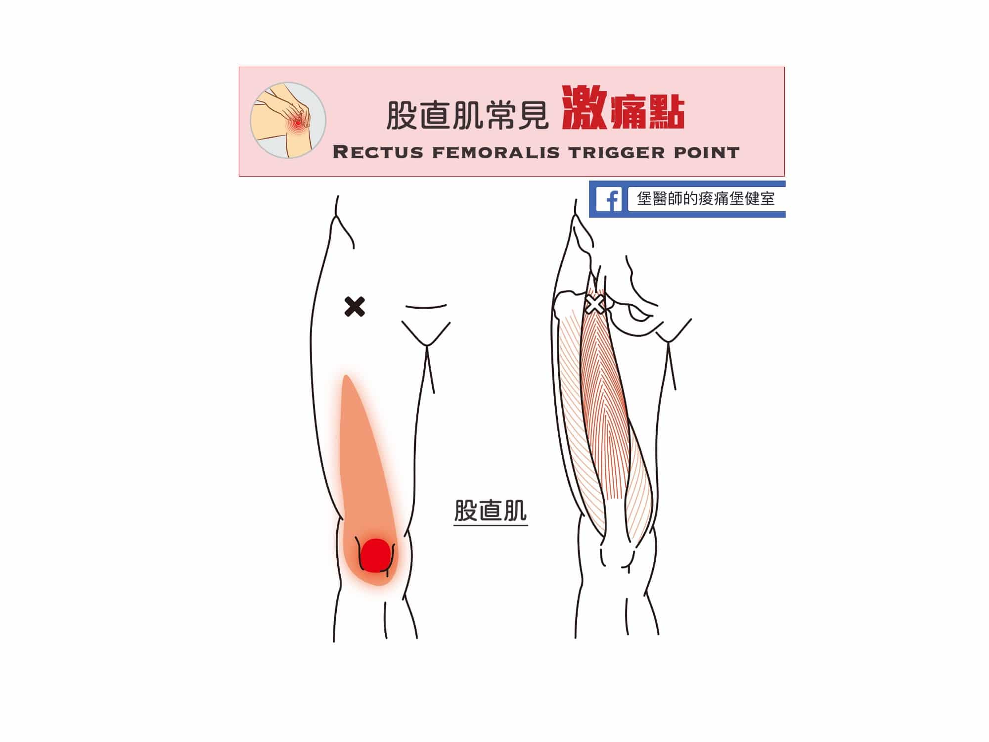 大腿膝蓋痛-股直肌常見激痛點