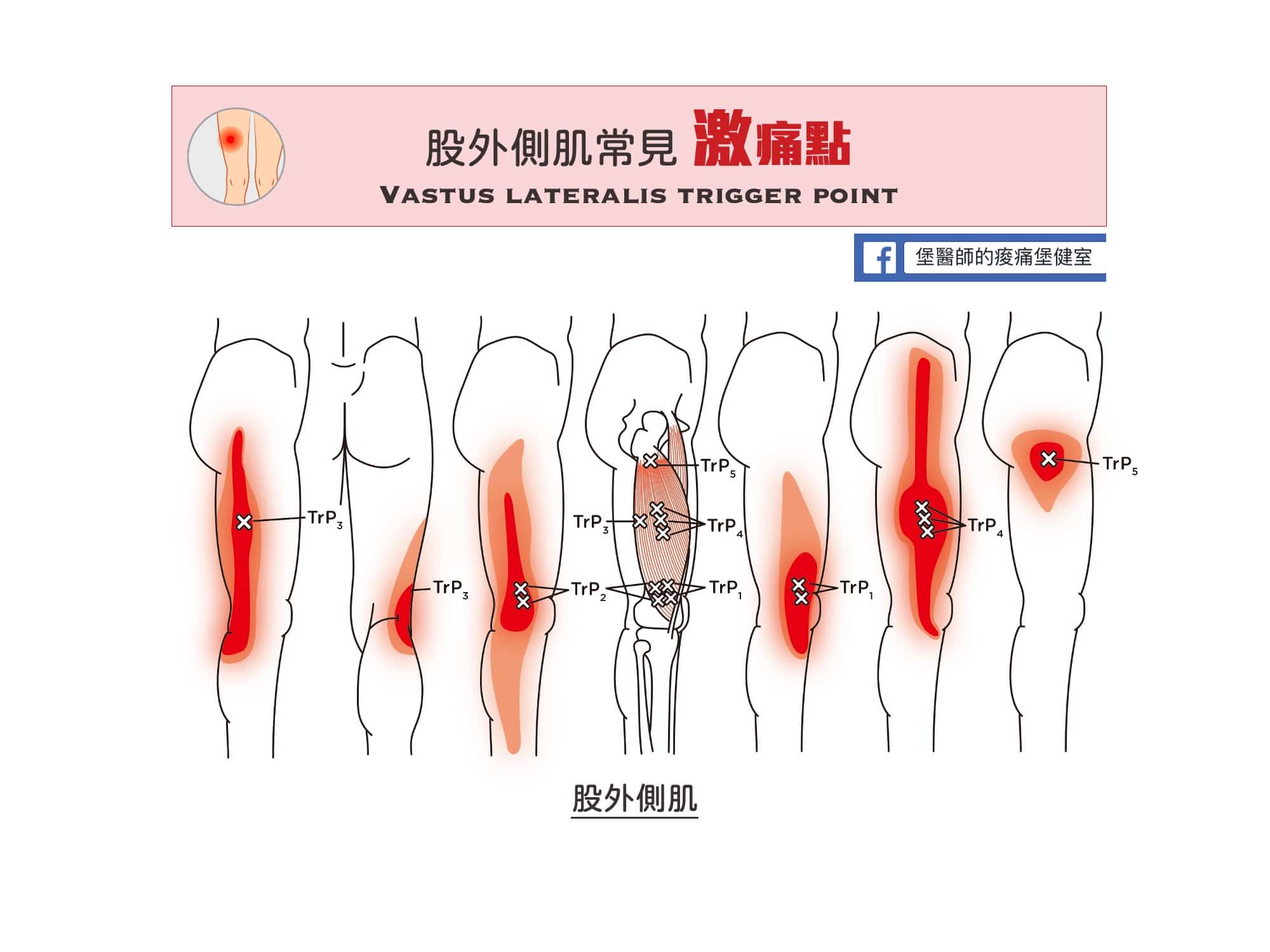 大腿膝蓋痛-股外側肌常見激痛點