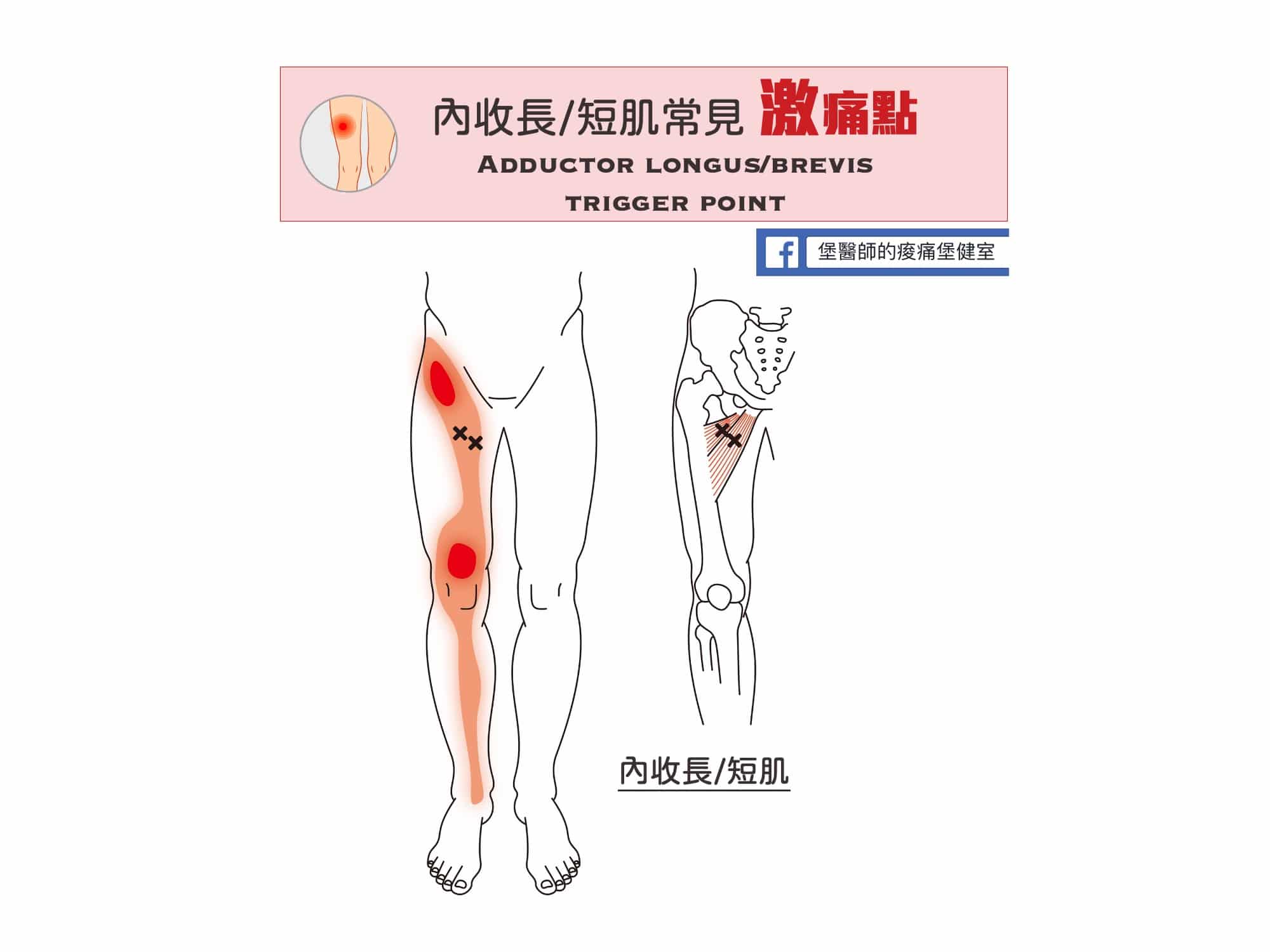 膝蓋大腿小腿內側痛-內收長短肌常見激痛點