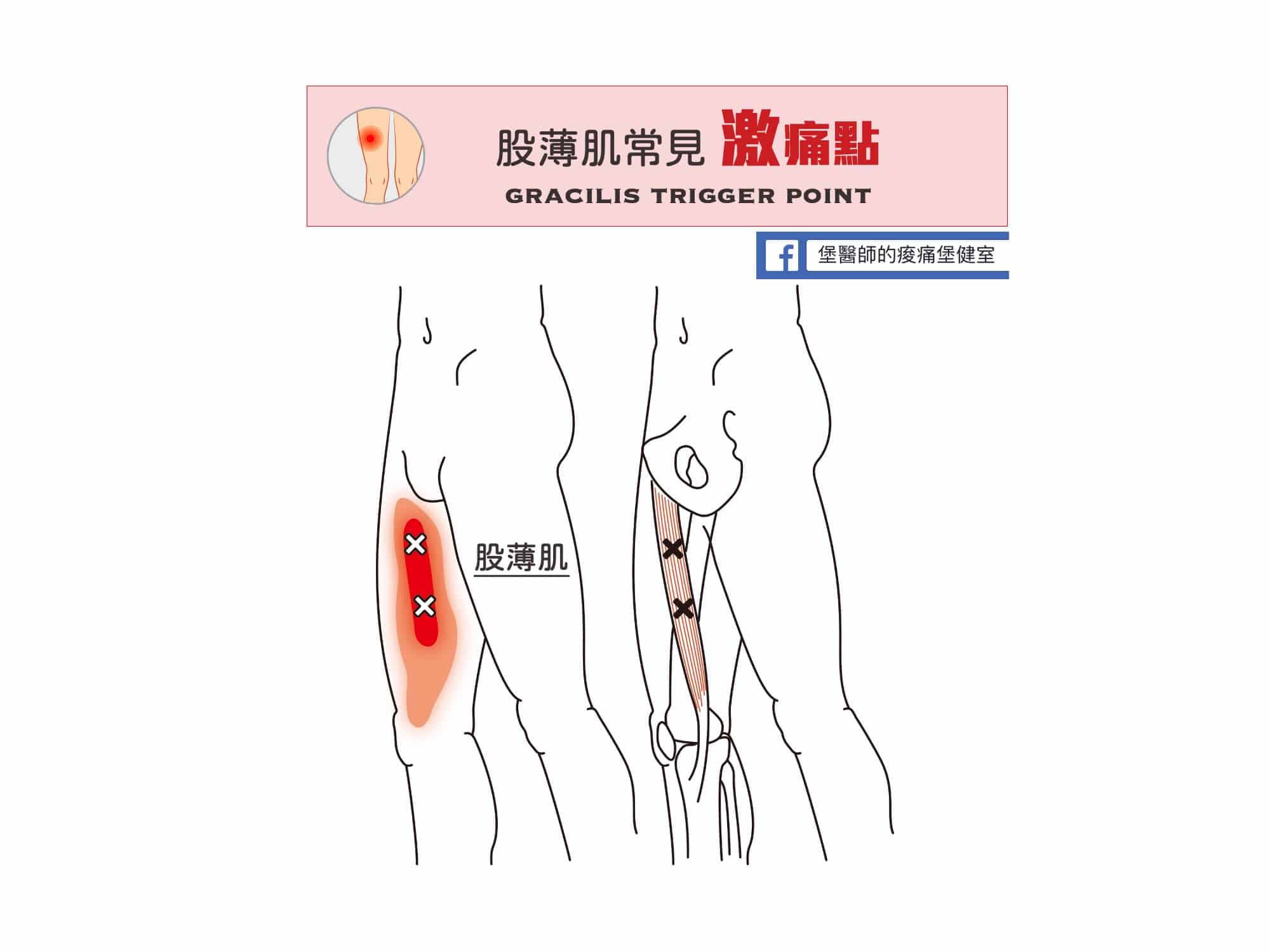 大腿痛-股薄肌常見激痛點