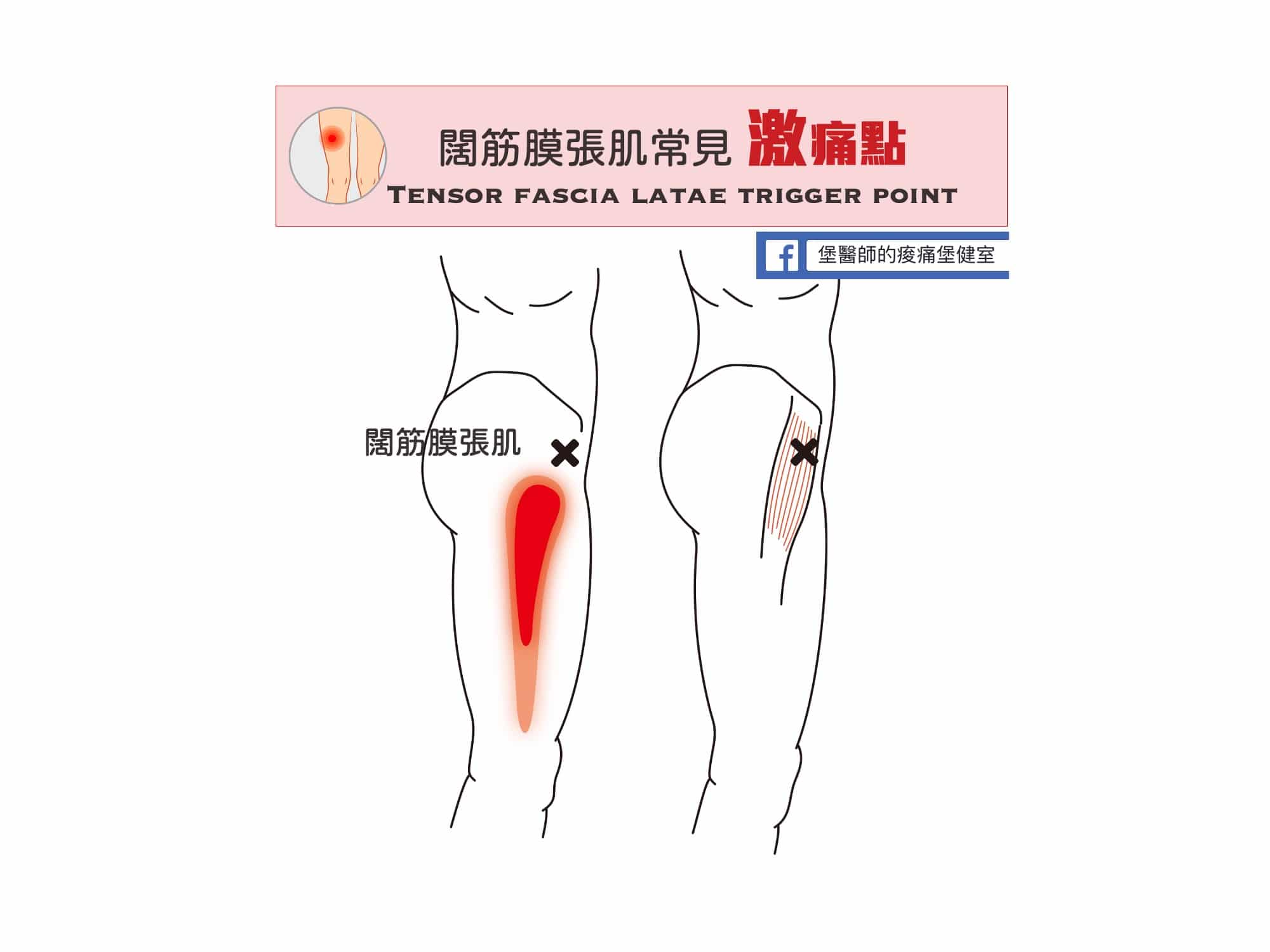 大腿痛-闊筋膜張肌