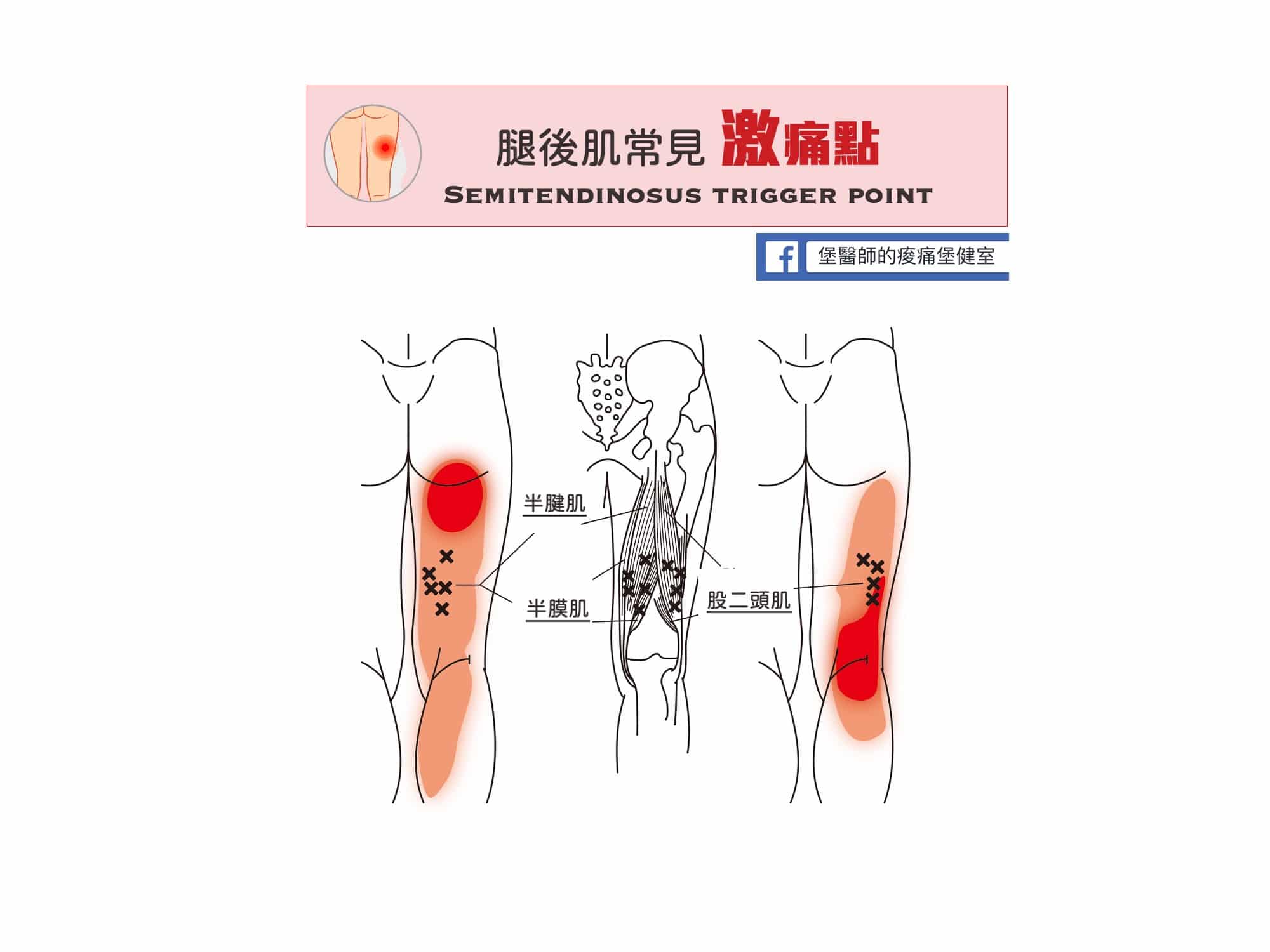 大腿痛膝蓋後側痛-腿後肌常見激痛點