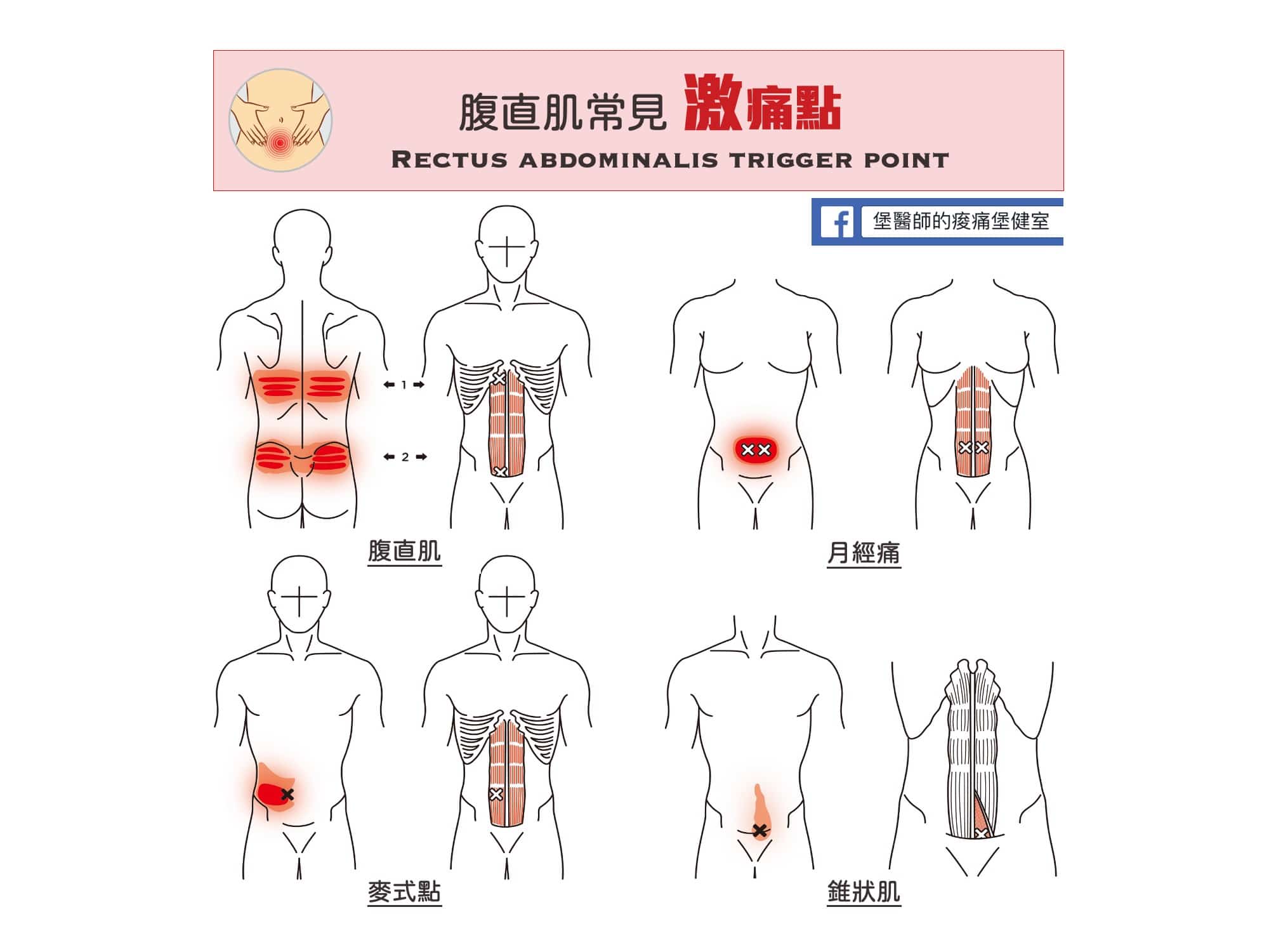 腰部腹部痛-腹直肌常見激痛點