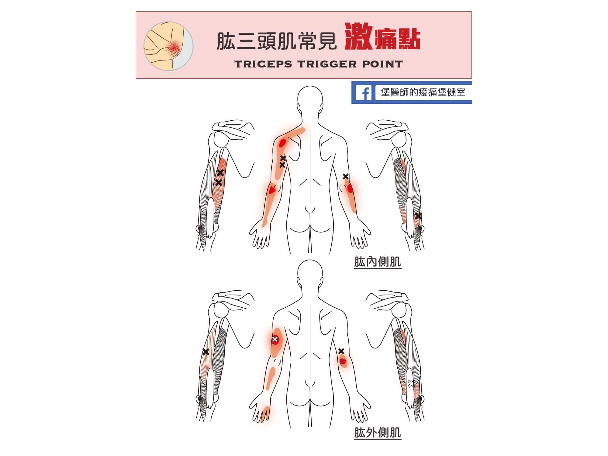 手臂肩膀痛-肱三頭肌常見激痛點