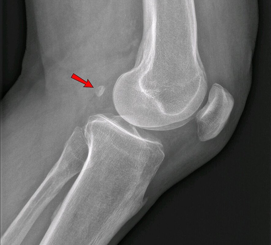 膝蓋後側痛 豆狀骨