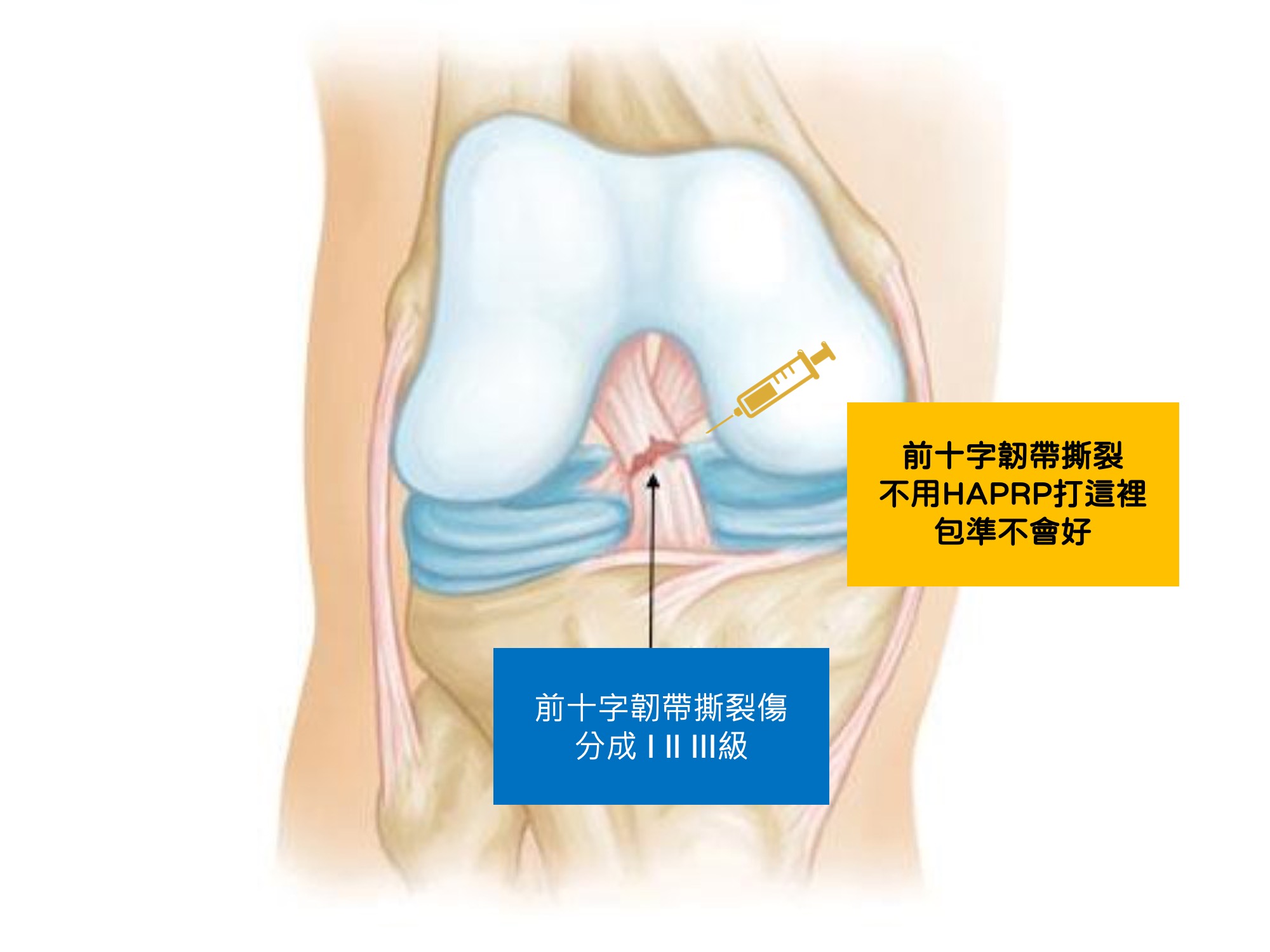 前十字韌帶撕裂打PRP才會好